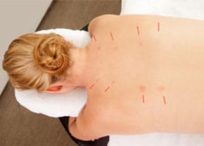 Acupuncture Back 300x200