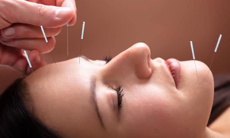 Facial Rejuvenation Acupuncture