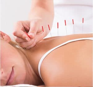 acupuncture for stress relief