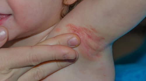 Candidiasis Of Skin Causing Rashes