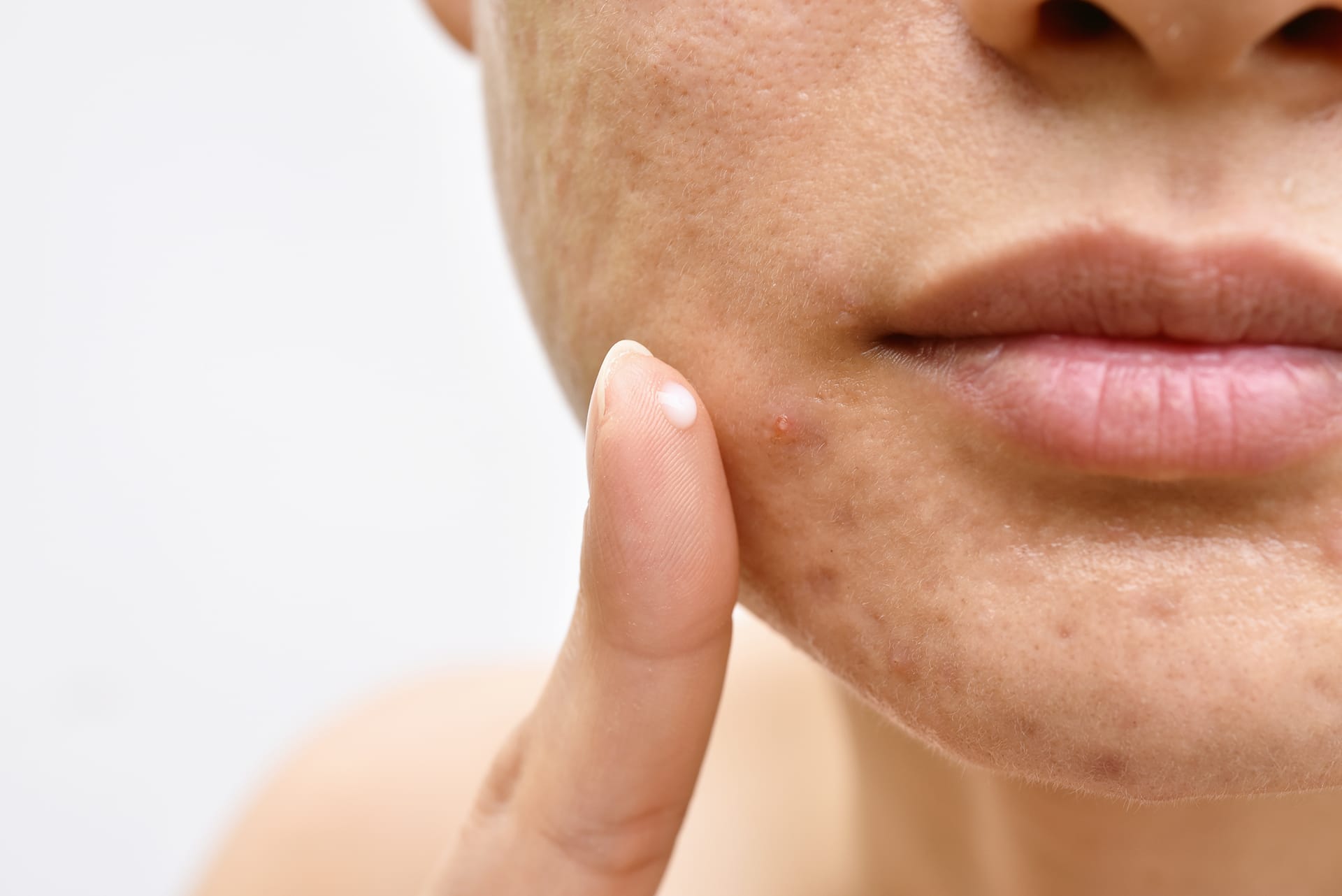 Are Your Hormones Causing Acne? Rose Wellness