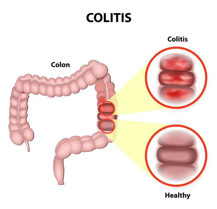 How ulcerative colitis affects the whole body
