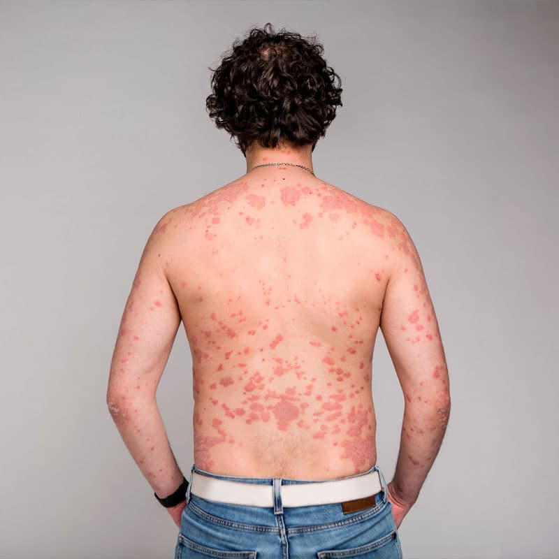 Psoriasis Autoimmune Disease