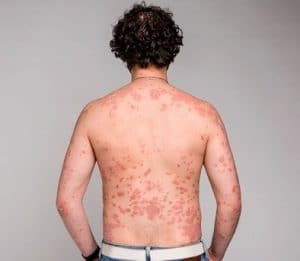 Skin Disorders-Epstein Barr Virus