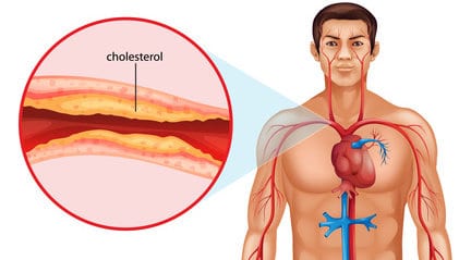 LDL vs HDL Cholesterol
