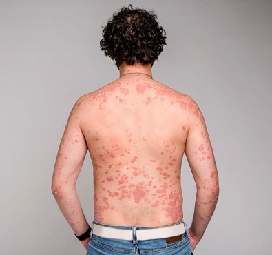 leaky gut symptoms
