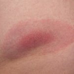 lyme borreliosis from a tick bite